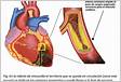 Angioplastia de resgate no infarto agudo do miocárdi